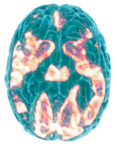 Colored brain scan showing neural activity.